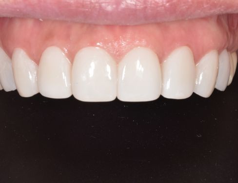 Implant
